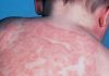 خشکی آتوپیک/Atopic dermatitis
