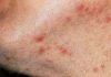 سودوفولیکولیت/Pseudofolliculitis
